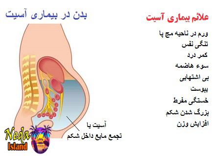 علائم بيماري آسیت