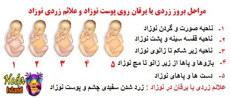 علائم بيماري زردی نوزاد علائم بيماري زردی نوزاد