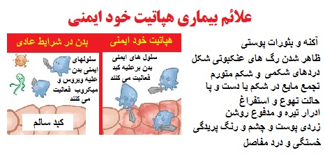 علائم بيماري هپاتیت خودایمنی