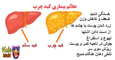 علائم بيماري کبد چرب