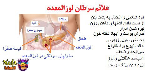 علائم بيماري سرطان لوزالمعده