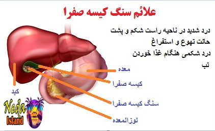 علائم بيماري سنگ کیسه صفرا