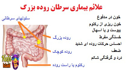 علائم بيماري سرطان روده بزرگ