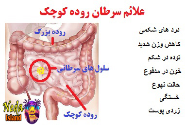 علائم بيماري سرطان روده کوچک