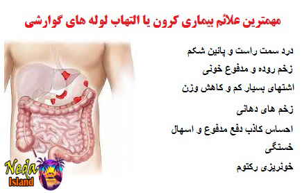  علائم بيماري کرون