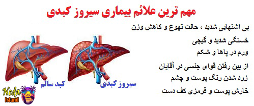 علائم بيماري سیروز کبدی