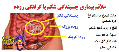علائم بيماري چسبندگی شکم