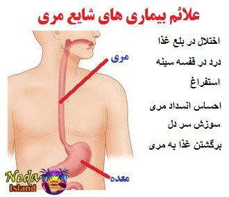 علائم بيماري مری