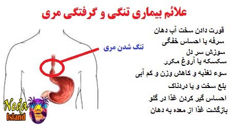 علائم بيماري تنگی مری