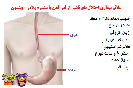 علائم بيماري سندرم پلامر-وینسون