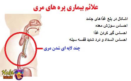 علائم بیماری پره های مری