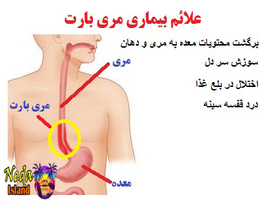 علائم بیماری مری بارت