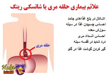 علائم بیماری حلقه مری