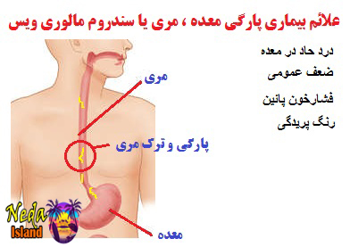 علائم سندرم مالوری ویس