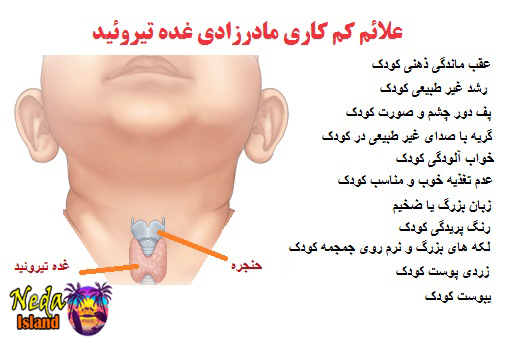 علائم بیماری کم کاری مادرزادی غده تیروئید