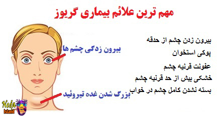 علائم بیماری گریوز