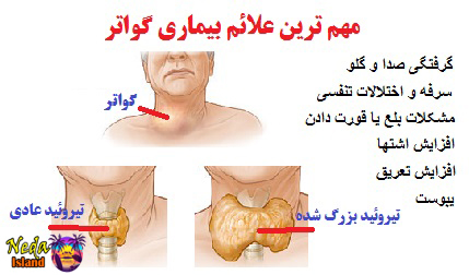 علائم بیماری گواتر