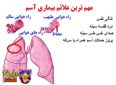 علائم بیماری آسم