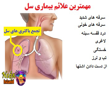 علائم بیماری سل