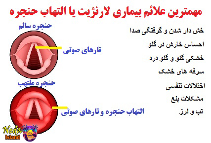 علائم بیماری التهاب حنجره یا لارنژیت