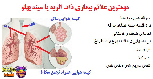 علائم بیماری ذات الریه یا سینه پهلو