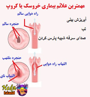 علائم بیماری خروسک یا کروپ
