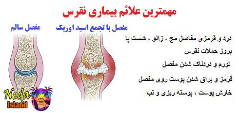 علائم بیماری نقرس