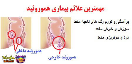 علائم بیماری هموروئید