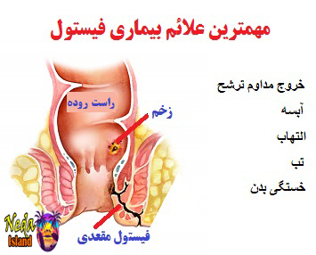 علائم بیماری فیستول