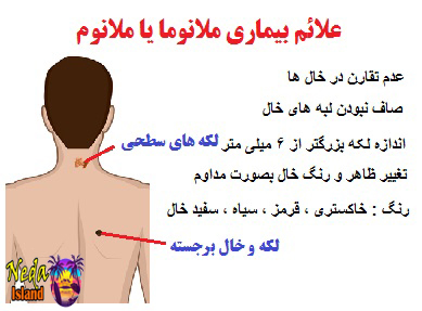 علائم بیماری ملانوما